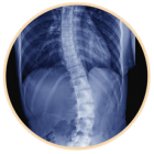 scoliosis-back-pain-osteopathy-canberra-woden-osteopath